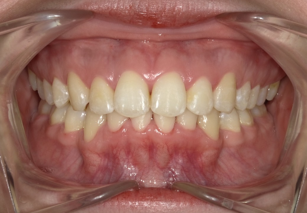 盛岡（盛岡市）の歯医者、医療法人啓仁会 栃内歯科医院の矯正歯科症例