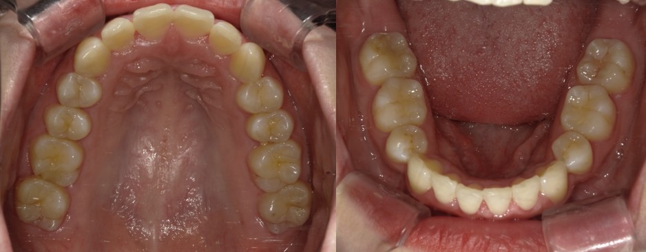 盛岡(盛岡市)の歯医者、医療法人啓仁会 栃内歯科医院の矯正歯科症例
