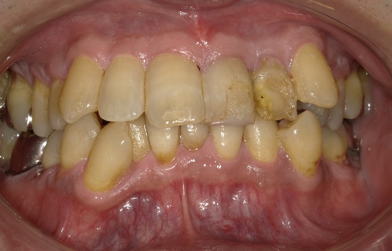 盛岡（盛岡市）の歯医者、医療法人啓仁会 栃内歯科医院の矯正歯科症例