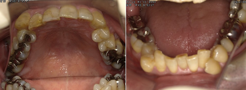 盛岡（盛岡市）の歯医者、医療法人啓仁会 栃内歯科医院の矯正歯科症例