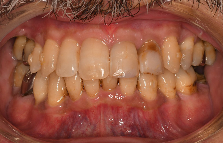 盛岡（盛岡市）の歯医者、医療法人啓仁会 栃内歯科医院の矯正歯科症例