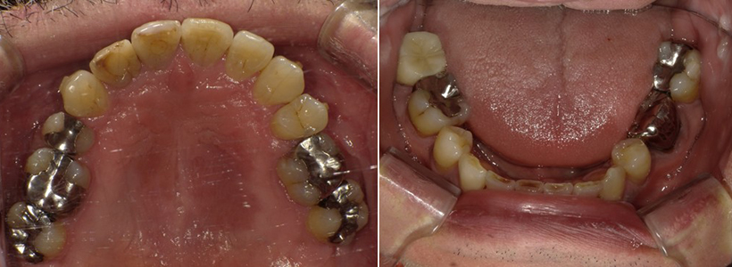 盛岡（盛岡市）の歯医者、医療法人啓仁会 栃内歯科医院の矯正歯科症例